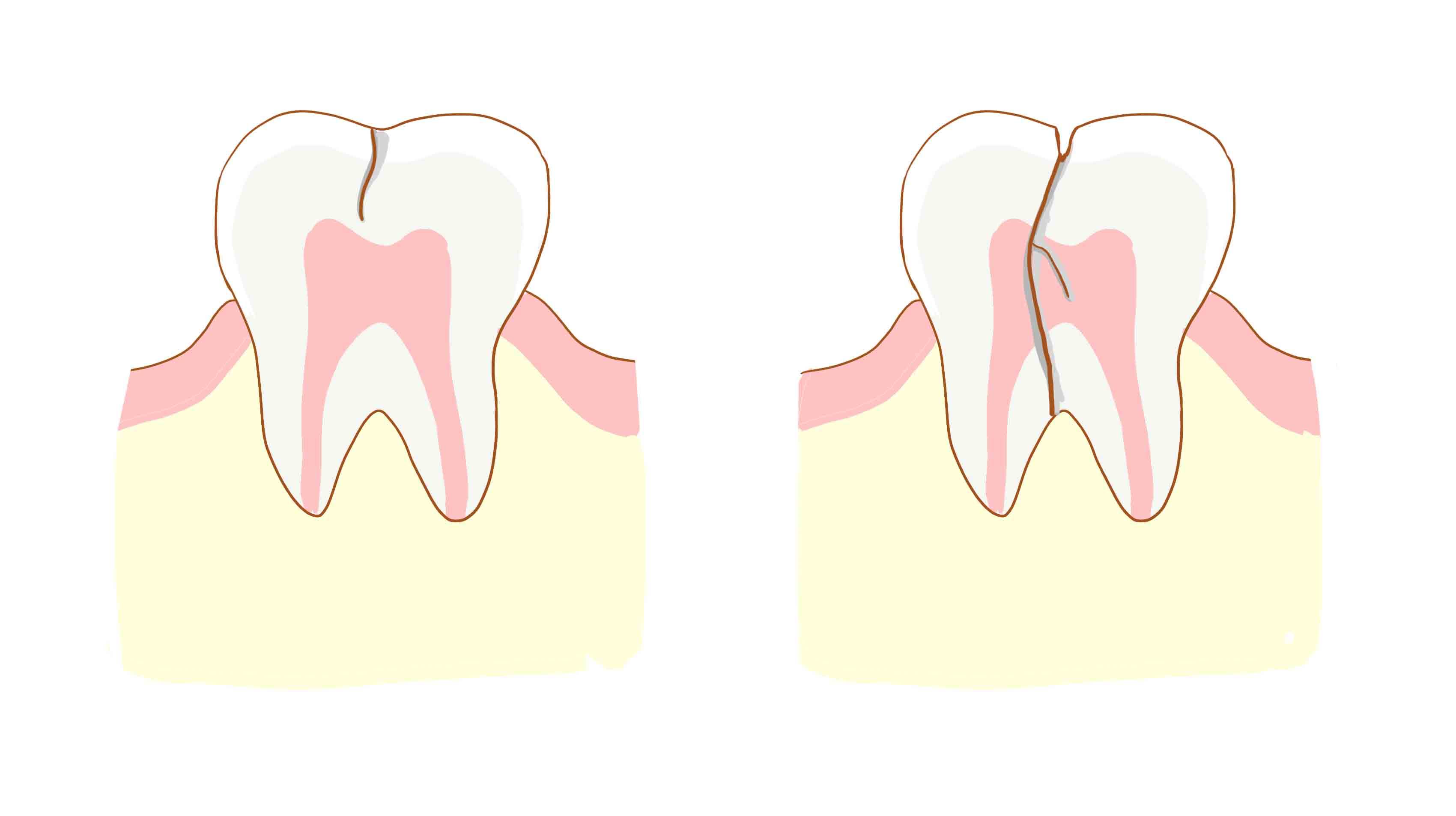 Dolor en la ilustración del diente roto 3d realista. | Vector Premium